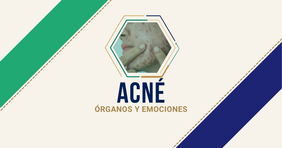 Acné: origen emocional según Biodesprogramación