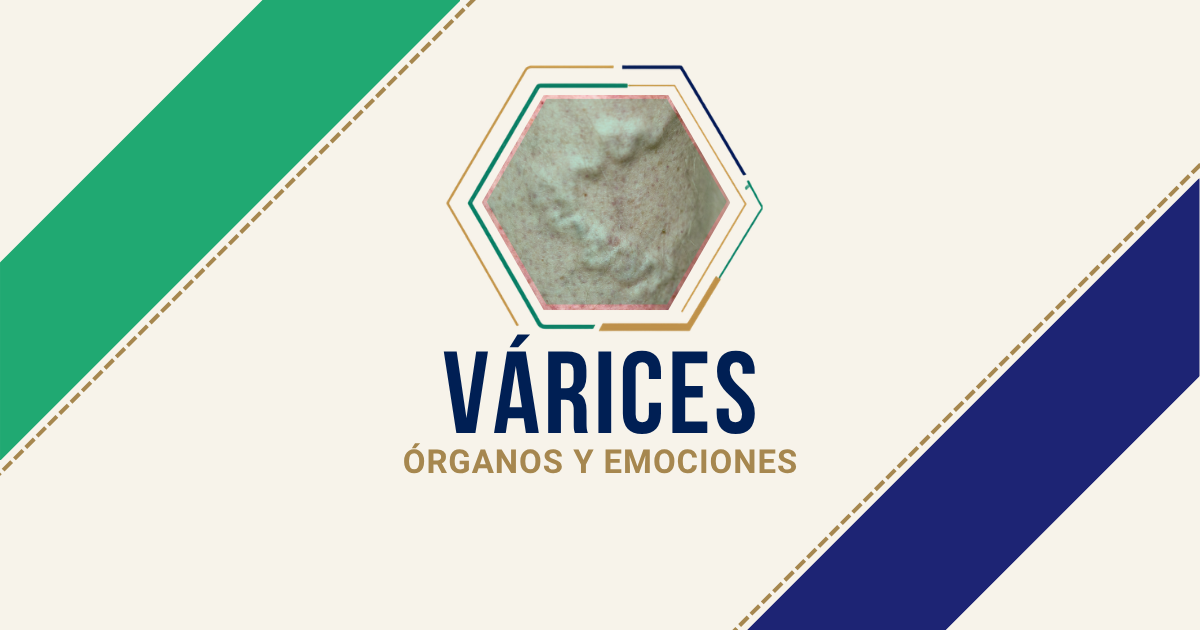 Várices: origen emocional según Biodesprogramación